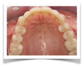 URGENCES ORTHODONTIQUES : LES SOLUTIONS